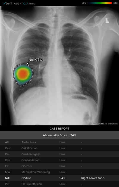 GE Healthcare lanza nuevo sistema de IA para detectar anomalías en radiografías torácicas